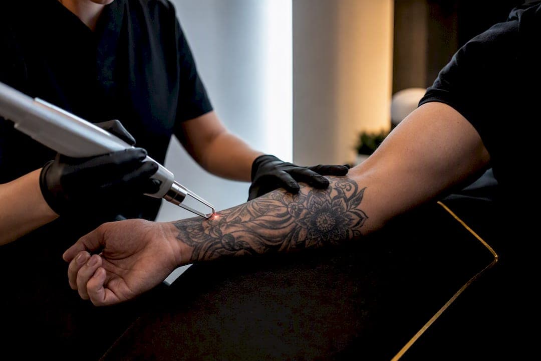Tattooentfernung und Betäubung: Welche Methode wirklich hilft